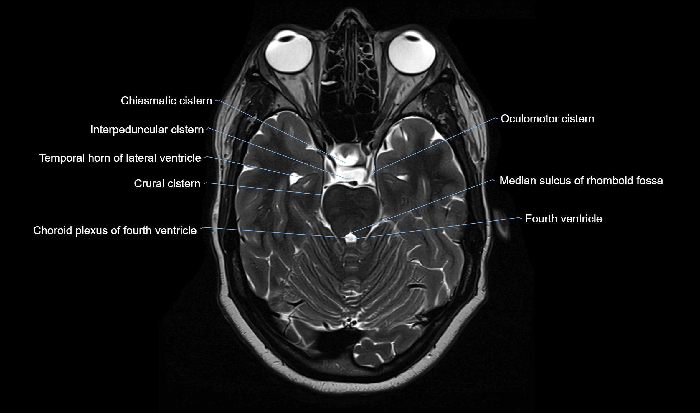 Brain cisterns  and ventricles  axial anatomy 3T MRI image-img-00001-00018.webp